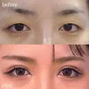 埋没二重４点留め before画像 サムネイル用