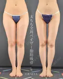 太腿全周ベイザー脂肪吸引 before画像 サムネイル用
