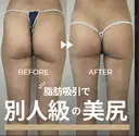 アキーセル　太もも脂肪吸引　フルコース before画像 サムネイル用