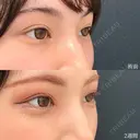 ヒアルロン酸ニューラミス(涙袋) before画像 サムネイル用