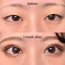 埋没二重術 before画像 サムネイル用