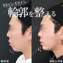 輪郭を整え、Sライン＆Eラインを作る😎 before画像 サムネイル用
