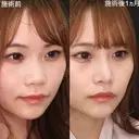 鼻先ツン🌷鼻筋の通った顔立ちに😌 30日後 サムネイル用