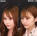鼻先ツン🌷鼻筋の通った顔立ちに😌 30日後 サムネイル用