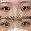 埋没二重術+目頭切開+涙袋ヒアルロン酸 before画像 サムネイル用