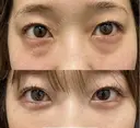 クマ取り+コンデンスリッチファット after画像 サムネイル用