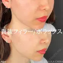 貴族フィラー after画像 サムネイル用