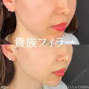 貴族フィラー before画像 サムネイル用