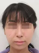 バッカルファット除去+メーラーファット除去+ツヤ肌コラーゲンリフト before画像 サムネイル用