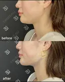 脂肪吸引注射（アゴ下） after画像 サムネイル用
