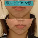 ヒアルロン酸注入（あご） 0日後 サムネイル用