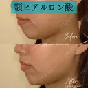 ヒアルロン酸注入（あご） 0日後 サムネイル用
