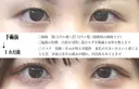 目頭切開+埋没法 30日後 サムネイル用