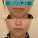 ヒアルロン酸注入（あご） 7日後 サムネイル用