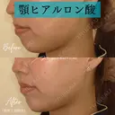 ヒアルロン酸注入（あご） 7日後 サムネイル用