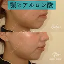ヒアルロン酸注入（あご） 7日後 サムネイル用