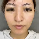 糸リフト before画像 サムネイル用
