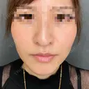 糸リフト after画像 サムネイル用