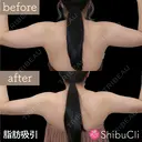 脂肪吸引 before画像 サムネイル用
