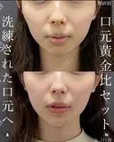 【口元黄金比セット】洗練された口元へ✨ 7日後 サムネイル用