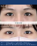 目頭切開 after画像 サムネイル用