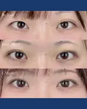 二重埋没法 before画像 サムネイル用