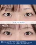 二重埋没法 after画像 サムネイル用