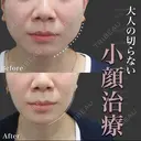 切らない小顔術｜エラボト＋スーパーHIFU pro after画像 サムネイル用