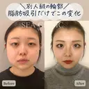 脂肪吸引(頬•顎下)/バッカルファット除去/顎ヒアルロン酸/エラボトックス/二重埋没法 before画像 サムネイル用