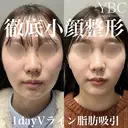 【🌟1dayVライン3D脂肪吸引🌟】 after画像 サムネイル用