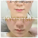 切らずに小顔|スーパーHIFUプロ before画像 サムネイル用