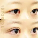 しっかり二重でどの角度でも可愛い|共立式二重埋没P-PL挙筋法 before画像 サムネイル用