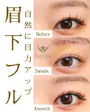 眉下切開・ROOF切除・眼窩脂肪移動 before画像 サムネイル用