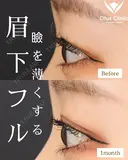 眉下切開・ROOF切除・眼窩脂肪移動 30日後 サムネイル用