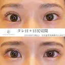 タレ目（埋没）+目尻切開 after画像 サムネイル用
