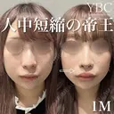 【人中短縮術】 after画像 サムネイル用
