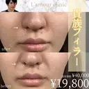 貴族フィラー before画像 サムネイル用
