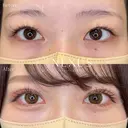 ネクサスアイズ(埋没法) before画像 サムネイル用