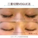 他院修正 二重切開VOGUE法💗 before画像 サムネイル用