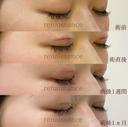 他院修正 二重切開VOGUE法💗 after画像 サムネイル用