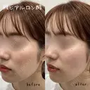 メリハリのある顔立ちに｜頬ヒアルロン酸 💉 after画像 サムネイル用