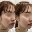 メリハリのある顔立ちに｜頬ヒアルロン酸 💉 after画像 サムネイル用