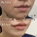 ぷっくりしたM字リップに💋｜唇ヒアル before画像 サムネイル用