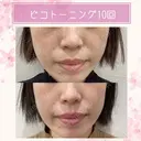 ピコトーニング｜シミやくすみを改善してワントーンUP🤍 before画像 サムネイル用