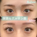 愛らしい目元に💗涙袋ヒアル before画像 サムネイル用