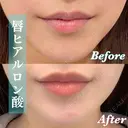 ぷっくりしたM字リップに💋｜唇ヒアル after画像 サムネイル用