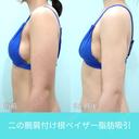 二の腕大量脂肪吸引でも、超滑らかで自然な仕上がり。吸引後の違和感全くなし！ 180日後 サムネイル用