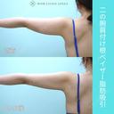 二の腕大量脂肪吸引でも、超滑らかで自然な仕上がり。吸引後の違和感全くなし！ 180日後 サムネイル用