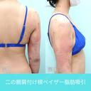 二の腕大量脂肪吸引でも、超滑らかで自然な仕上がり。吸引後の違和感全くなし！ 1日後 サムネイル用