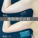 振り袖の部分痩せ❗脂肪吸引注射 💉 30日後 サムネイル用